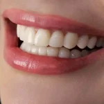 مزایا و معایب لمینت دندان