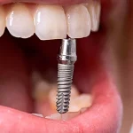 کاربردهای ایمپلنت‌های دندان
