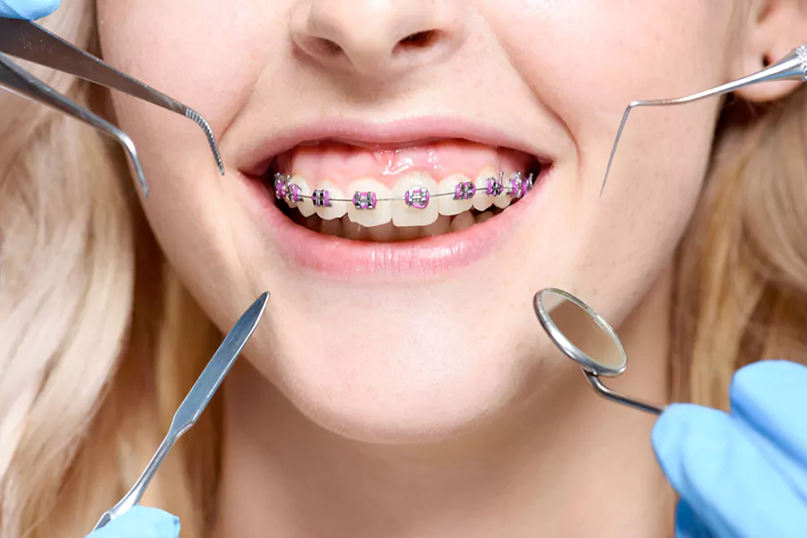 آیا ارتودنسی دندان عوارض به همراه دارد؟