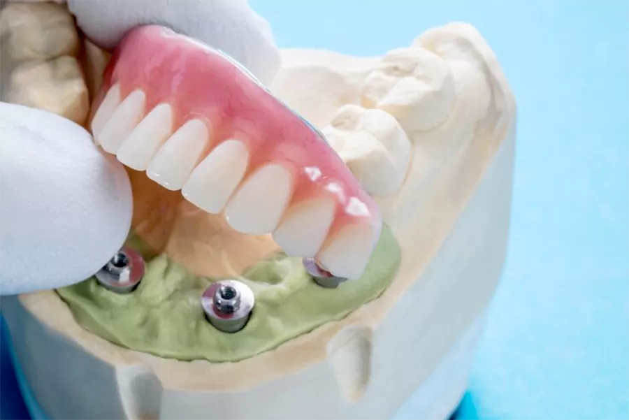 کاربرد روش های مختلف ایمپلنت دندان