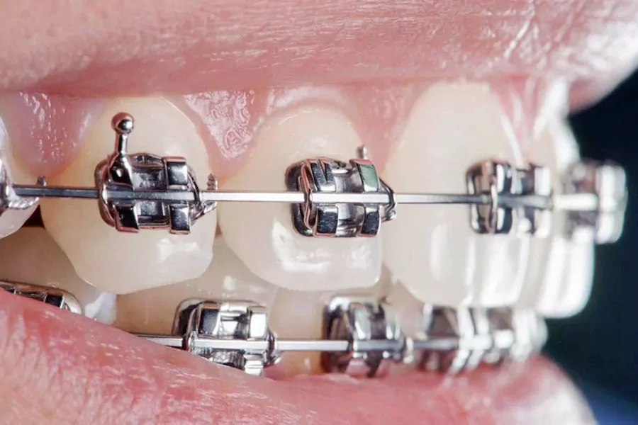 آیا کشیدن دندان در طول درمان ارتودنسی عوارضی را در پی خواهد داشت؟