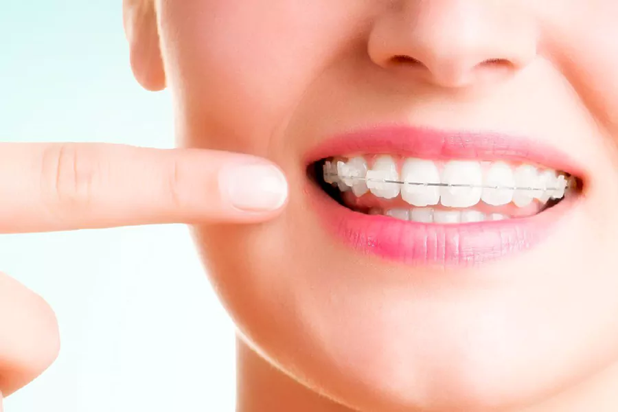 معایب انواع ارتودنسی دندان