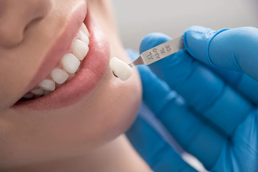 کدام روش لمینت دندان بهتر است؟