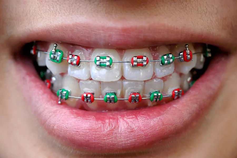 مزیت ارتودنسی دندان بزرگسالان