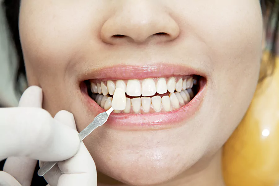 استفاده از پراکسید هیدروژن برای سفید کردن کامپوزیت دندان