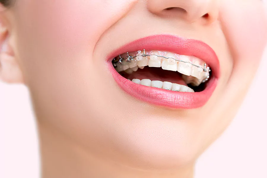 عوارض عدم استفاده از درمان ارتودنسی دندان