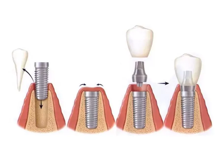 مراحل کاشت ایمپلنت فوری دندان