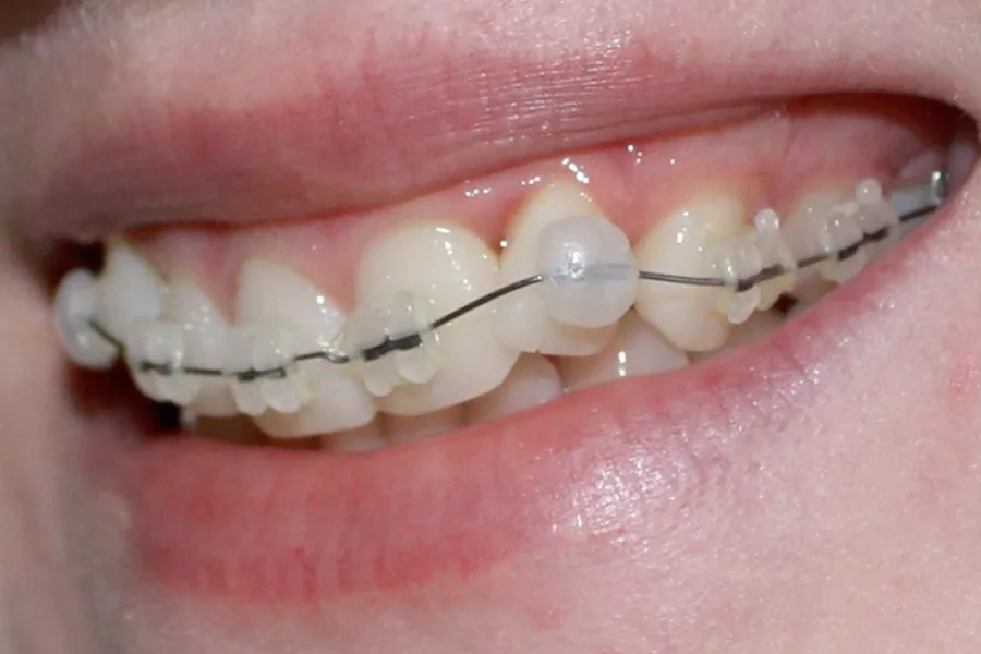 هزینه ارتودنسی دندان نیش در کلینیک لبخند درمان