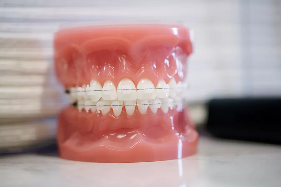 راه های جایگزین ارتودنسی برای درمان دندان نیش