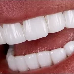 ونیر دندان چیست؟