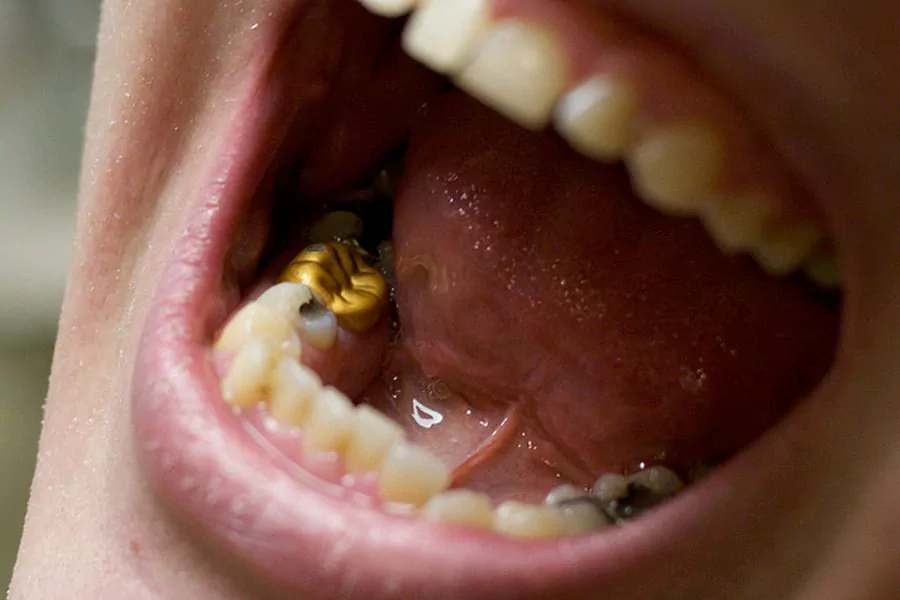مزیت استفاده از دندان طلا