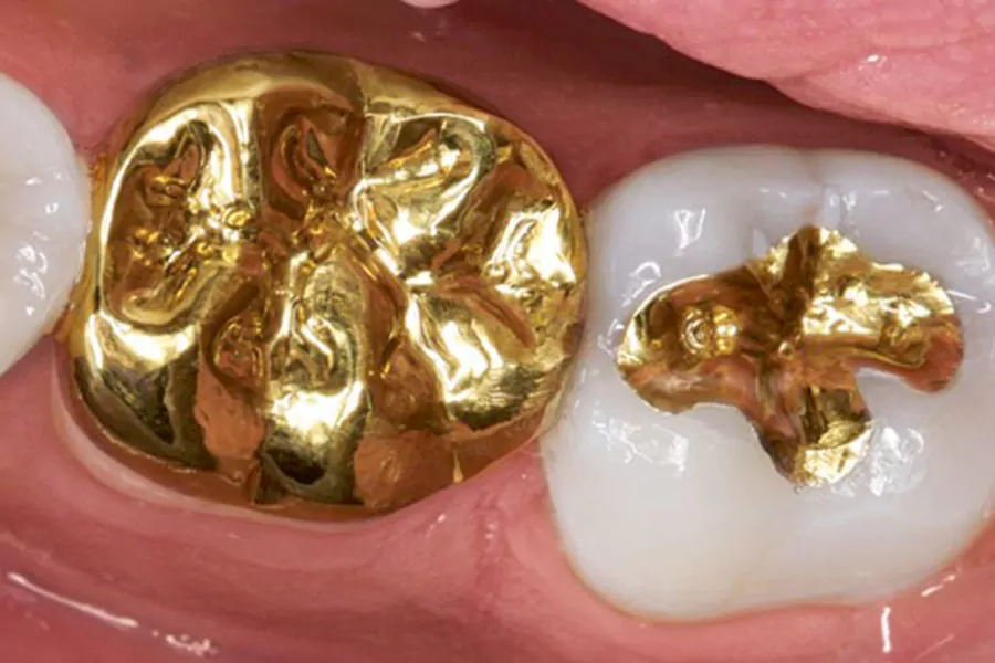 دندان طلا؛ بهترین و ماندگارترین روکش دندان