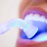 تفاوت بلیچینگ و کامپوزیت دندان