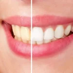 علت زرد شدن کامپوزیت دندان