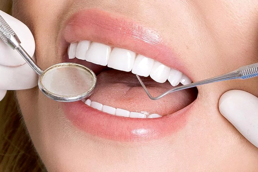 مراحل جایگذاری لمینت دندان به ترتیب کدامند؟