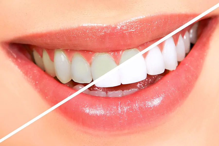  کاربرد بلیچینگ دندان