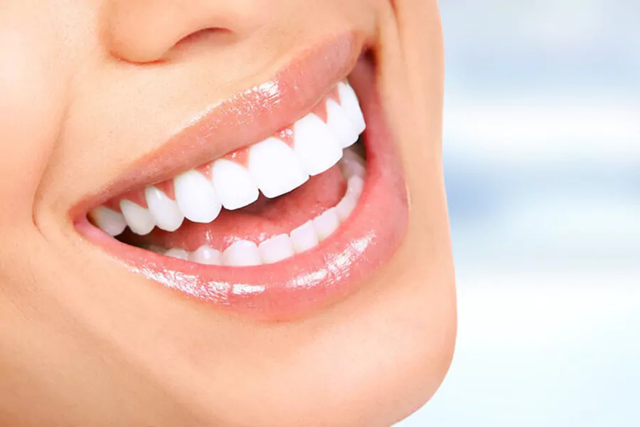  بلیچینگ دندان چقدر دوام دارد؟