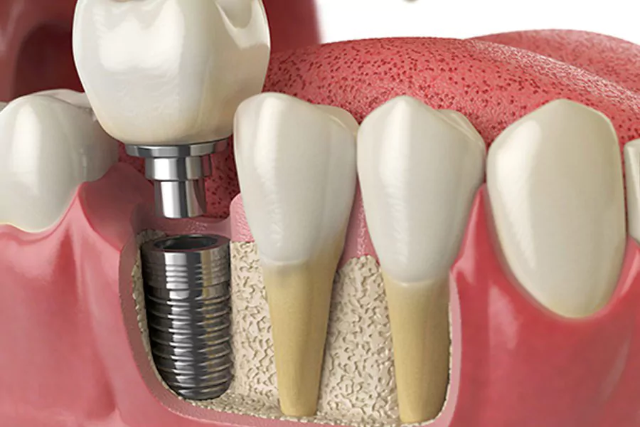 نوع ایمپلنت دندان