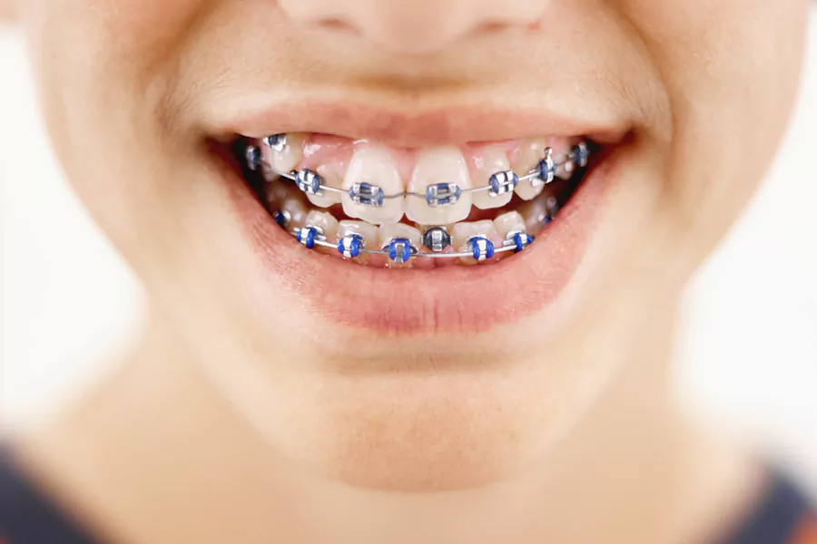 روش های ارتودنسی دندان نیش