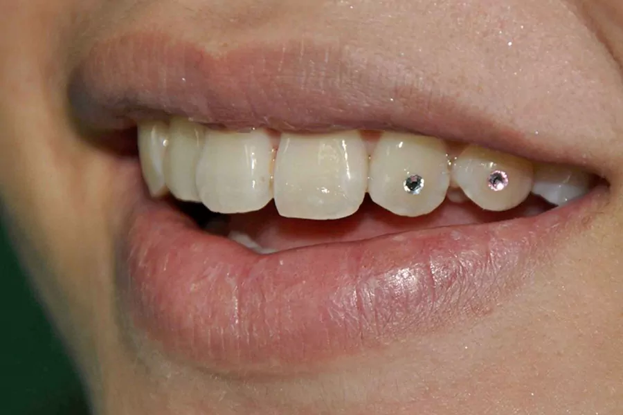 عوارض کاشت نگین دندان