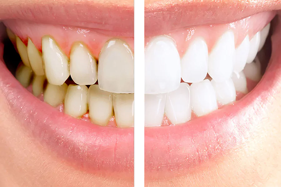 مهمترین مزایا و معایب جرم‌ گیری دندان چیست؟