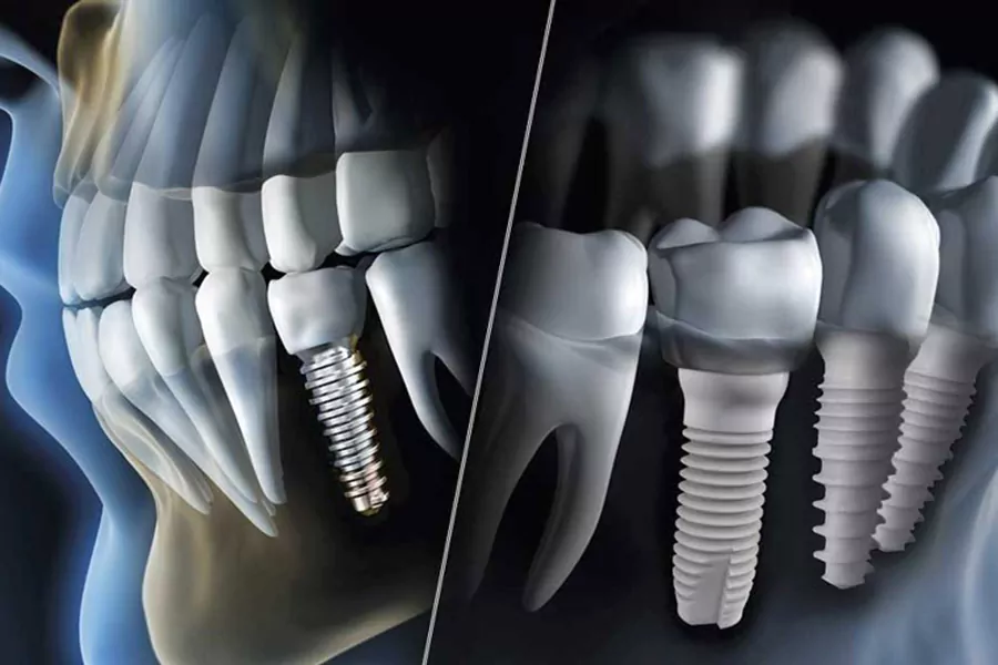 راهکارهایی برای افزایش طول عمر ایمپلنت دندان
