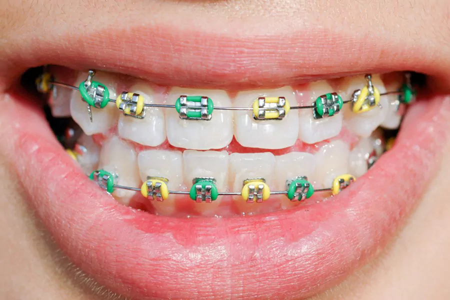 الاستیک یا کش ارتودنسی؛ مهمترین اجزا ارتودنسی دندان