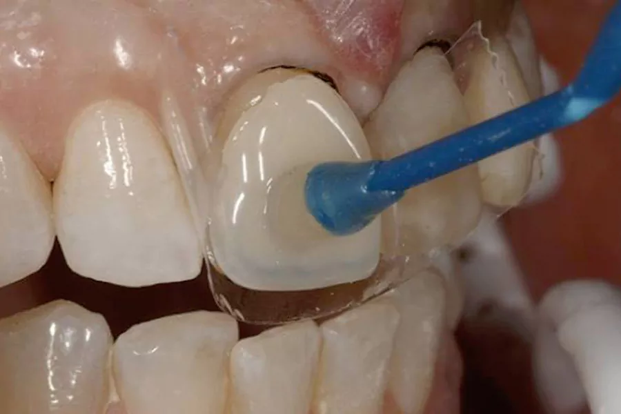 چه عواملی باعث طولانی شدن مراحل انجام لمینت دندان می شوند؟