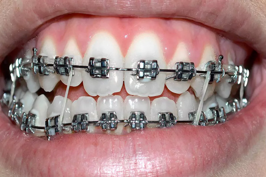 کش ارتودنسی چگونه به ارتودنسی دندان متصل می شود؟