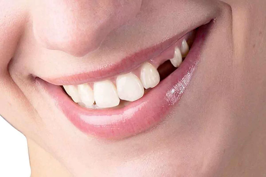 آیا ترمیم خانگی دندان شکسته ممکن است؟
