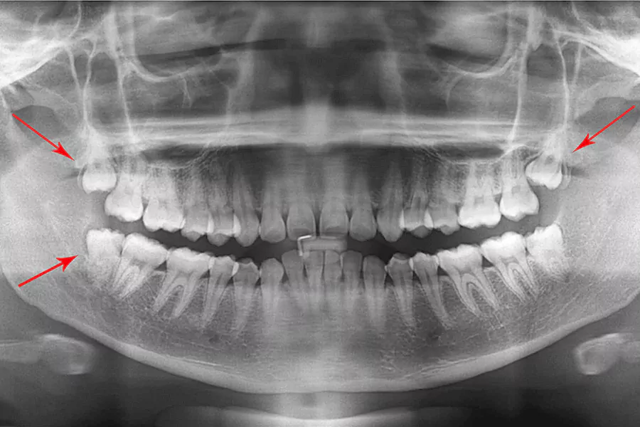 چه زمان نیاز به جراحی دندان عقل داریم؟