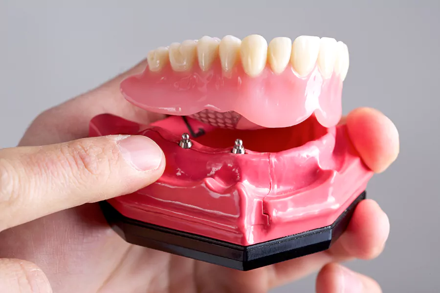 دندان مصنوعی ثابت یا بریج دندان (پل دندانی)