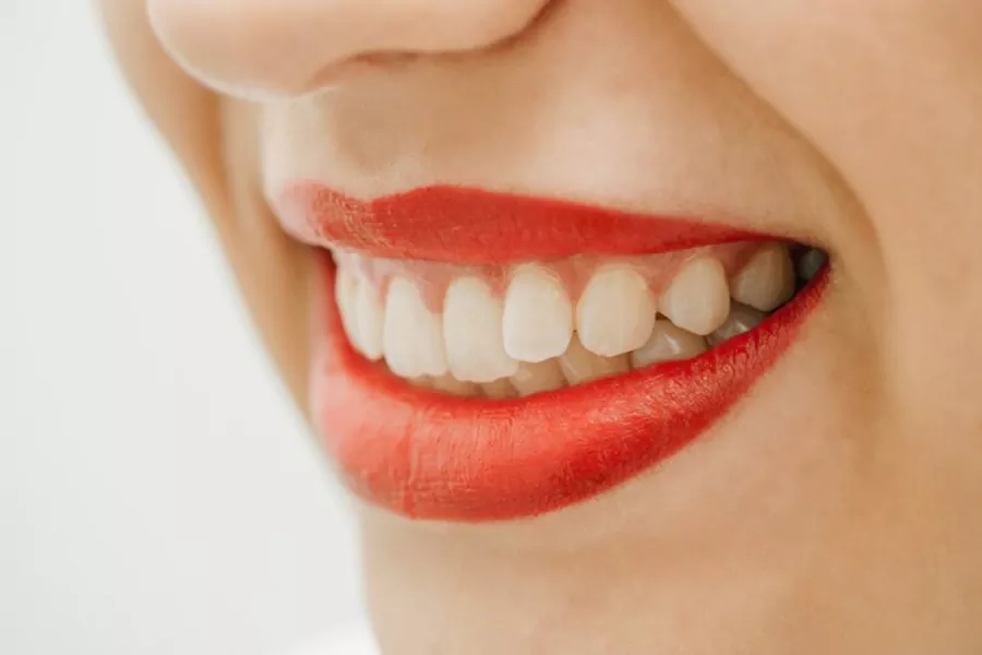  قیمت بلیچینگ دندان در کلینیک لبخند درمان