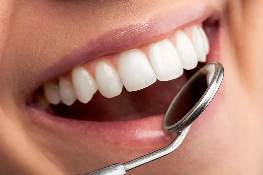تفاوت بلیچینگ و کامپوزیت دندان