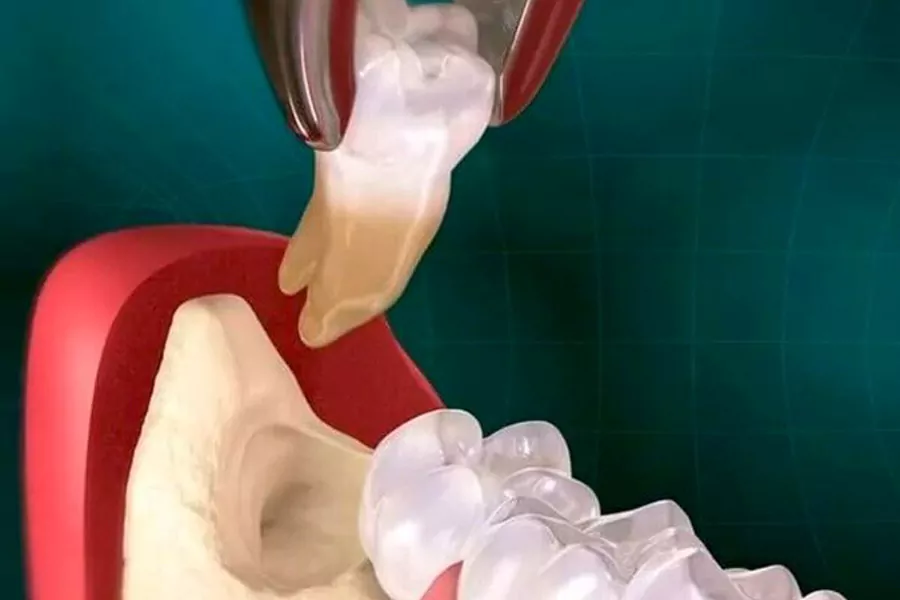درد ناشی از کشیدن دندان عقل