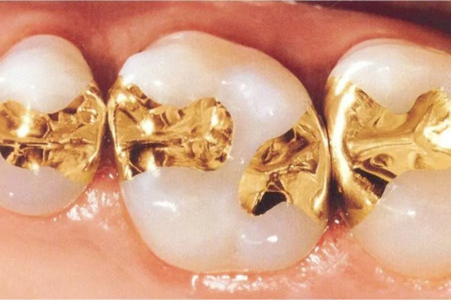 مزایا و معایب ترمیم دندان