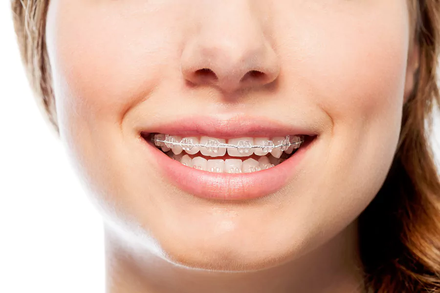 مزایای ارتودنسی دندان در سنین بالا