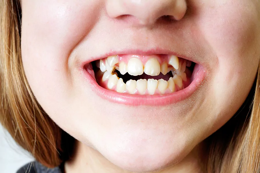 چرا دندان های نیش نا هماهنگ می شوند؟
