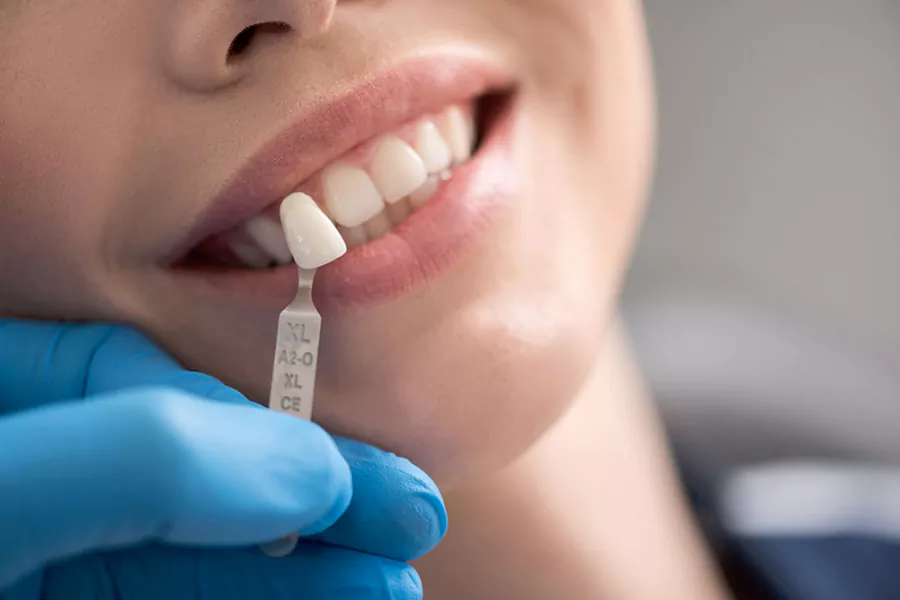 مقایسه هزینه بلیچینگ و کامپوزیت دندان