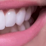 عوارض لمینت دندان