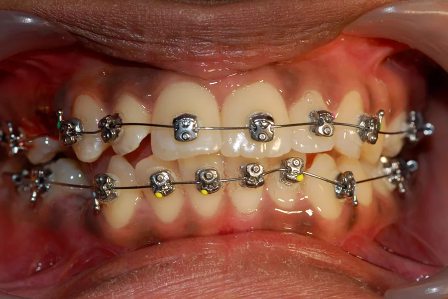 مراحل ارتودنسی دندان نیش