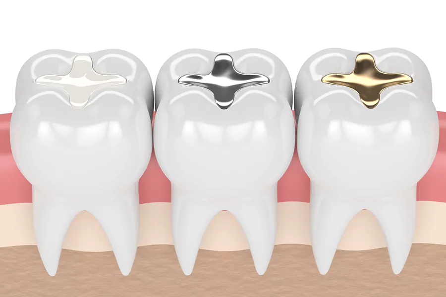 مواد مورد استفاده برای ترمیم دندان