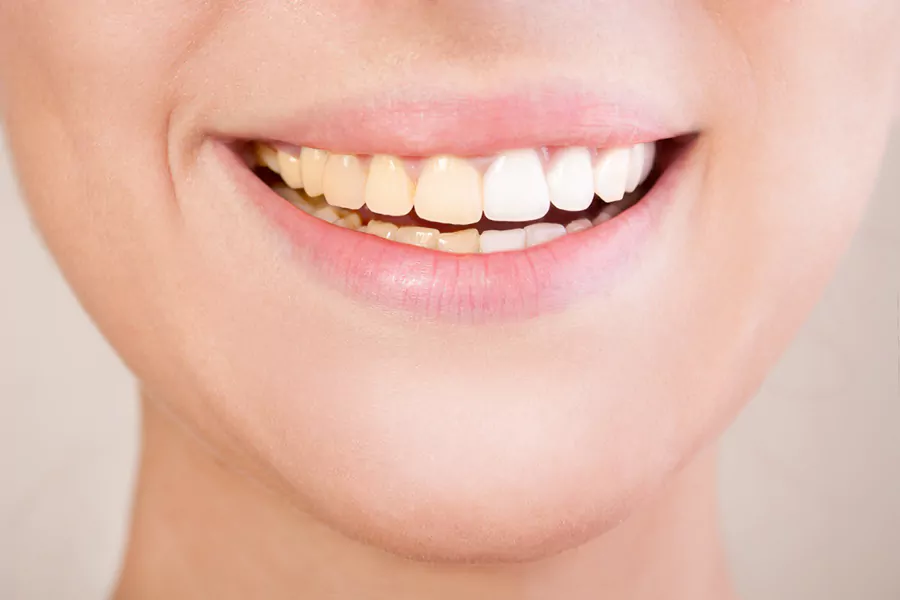 علت زرد شدن کامپوزیت دندان