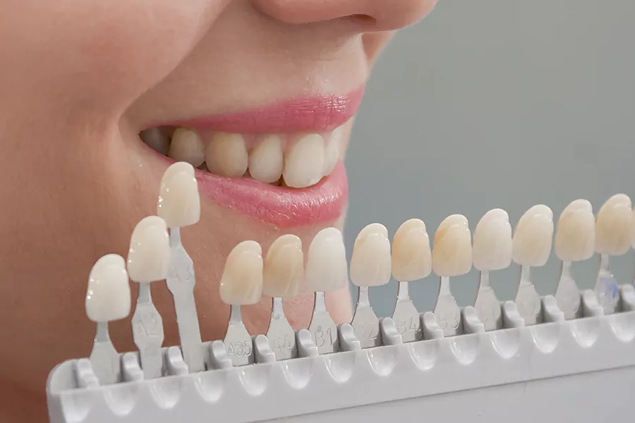 بهترین برند کامپوزیت دندان چه ویژگی هایی دارد؟