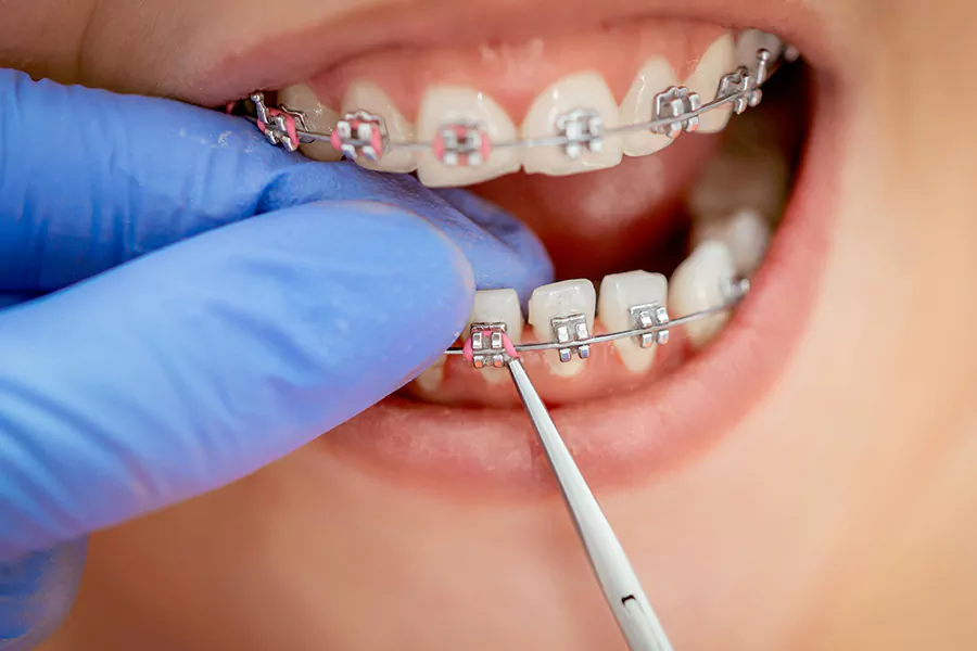 ارتودنسی دندان؛ ماندگارترین روش اصلاح دندان