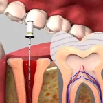 عصب‌ کشی مجدد دندان