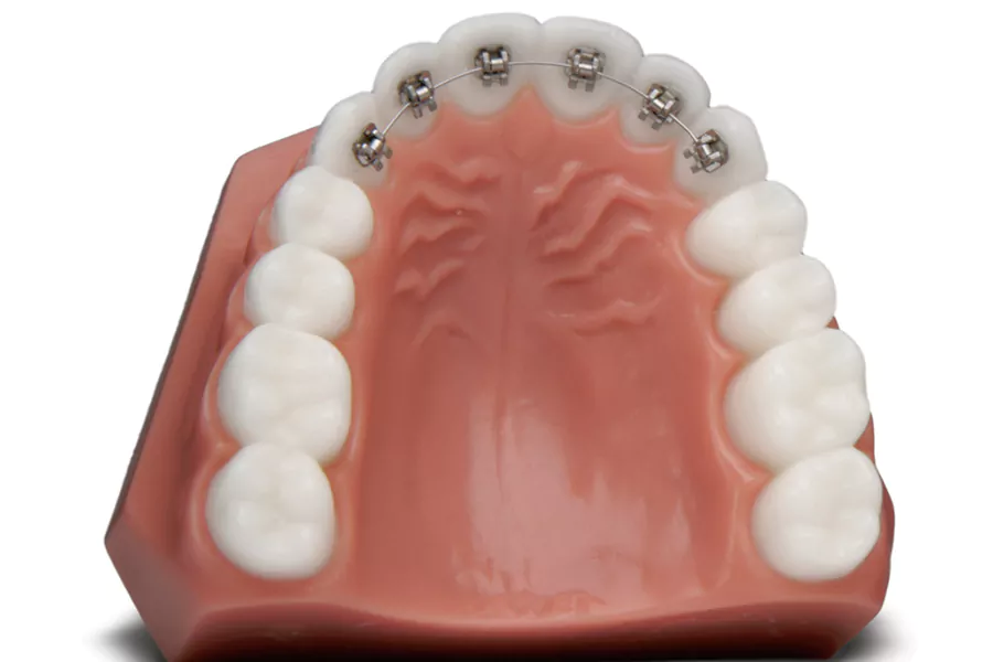 مراحل ارتودنسی نامرئی دندان