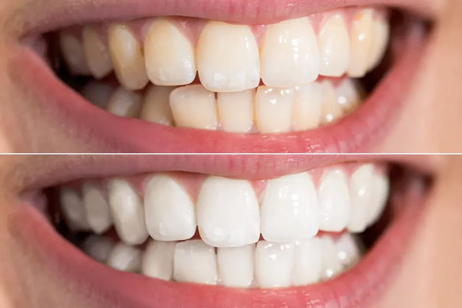 عوامل موثر بر کاهش طول عمر بلیچینگ دندان