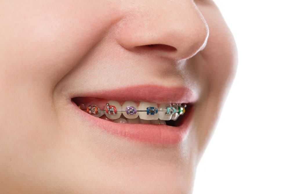 ارتودنسی دندان برای چه کسانی است
