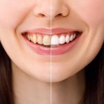 زرد شدن کامپوزیت دندان و چگونگی سفید کردن آن